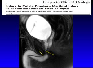 Urethral Surgery